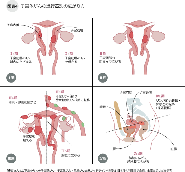 子宮体がんの進行器別の広がり方