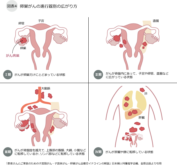 子宮体がんの進行器別の広がり方