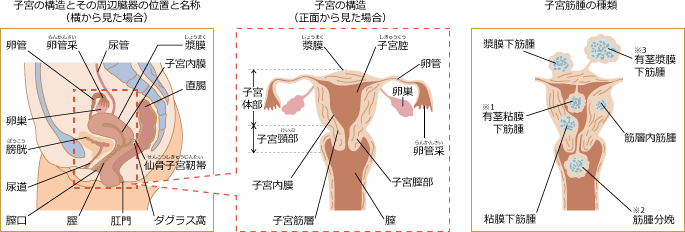 子宮筋腫とは